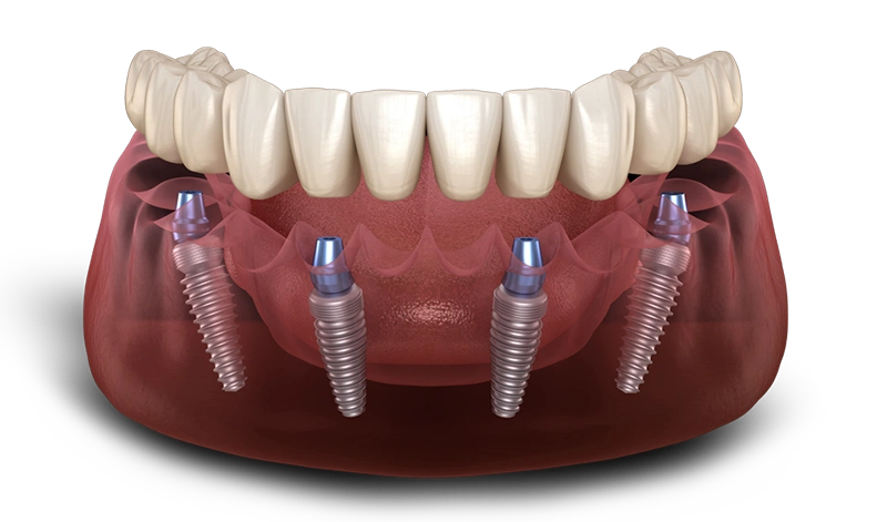 All On 4 Dental Implants