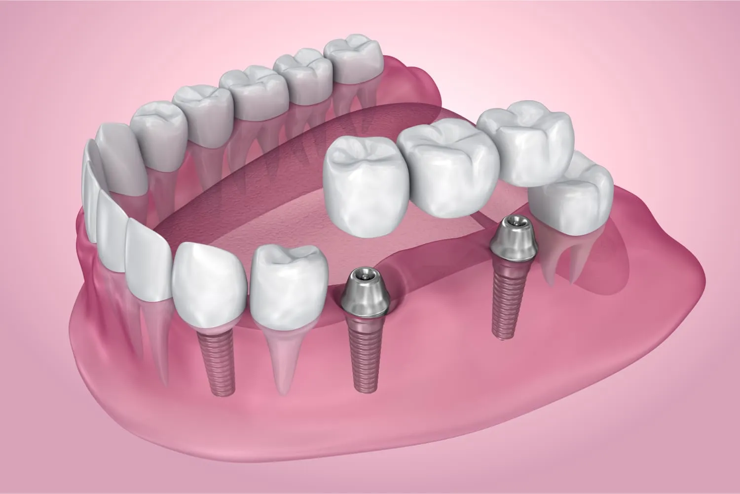 Dental Crowns and Bridges