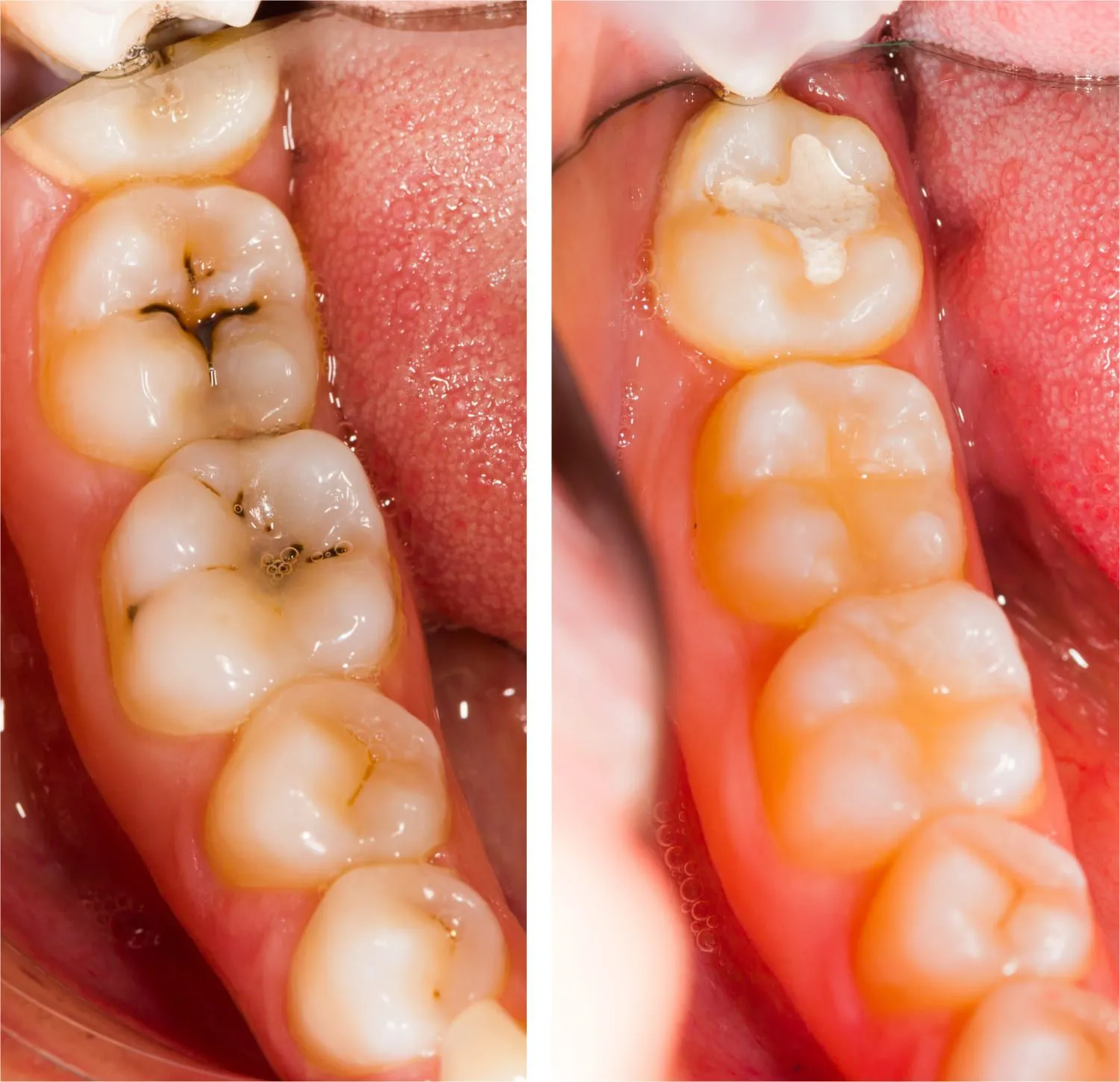 Tooth-colored composite dental filling