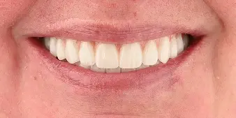 Dental Implants After