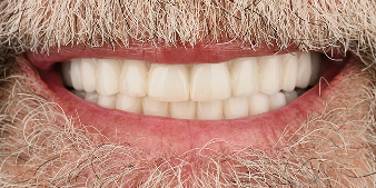 After dental treatment