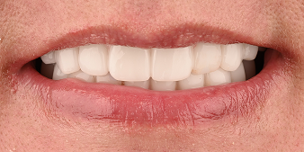 After dental treatment