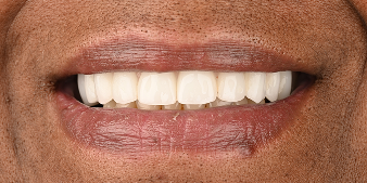 After dental treatment