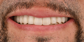 After dental treatment