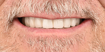 After dental treatment