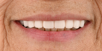 After dental treatment