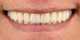 After dental treatment