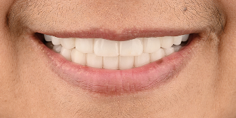 After dental treatment