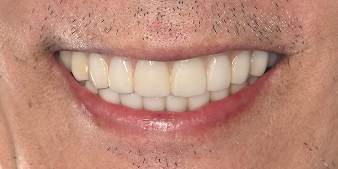 After dental treatment