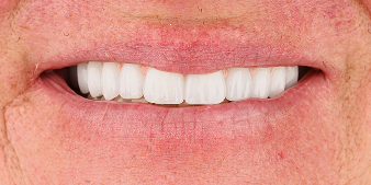 After dental treatment