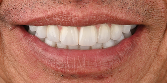 After dental treatment