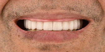 After dental treatment