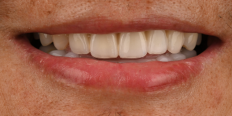 After dental treatment