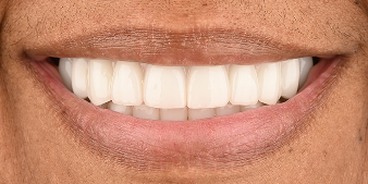 After dental treatment