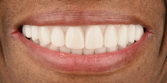 Cosmetic Dentistry After