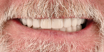 After dental treatment