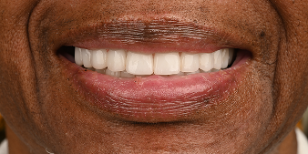 After dental treatment