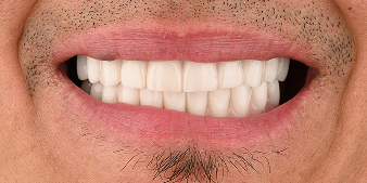 After dental treatment