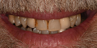 Before dental treatment