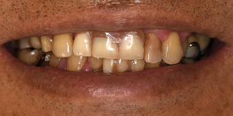 Before dental treatment