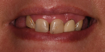 Before dental treatment