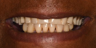 Before dental treatment