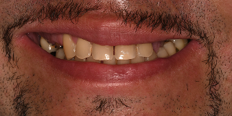 Before dental treatment