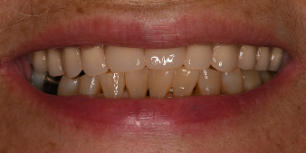 Before dental treatment