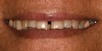 Before dental treatment