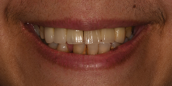 Before dental treatment