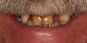 Before dental treatment