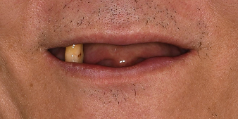 Before dental treatment