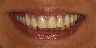 Before dental treatment