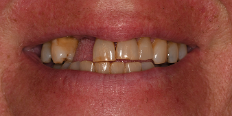 Before dental treatment