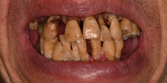 Before dental treatment