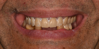 Before dental treatment