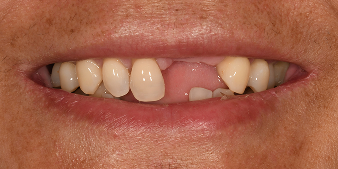 Before dental treatment