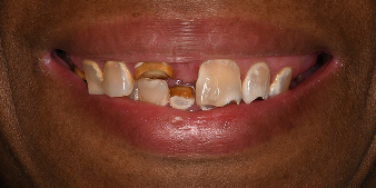 Cosmetic Dentistry Before