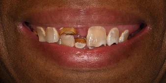 Cosmetic Dentistry Before