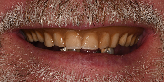 Before dental treatment