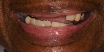 Before dental treatment