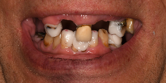 Before dental treatment