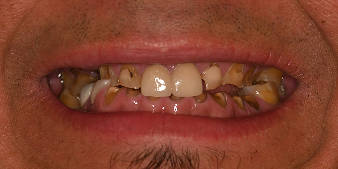 Before dental treatment