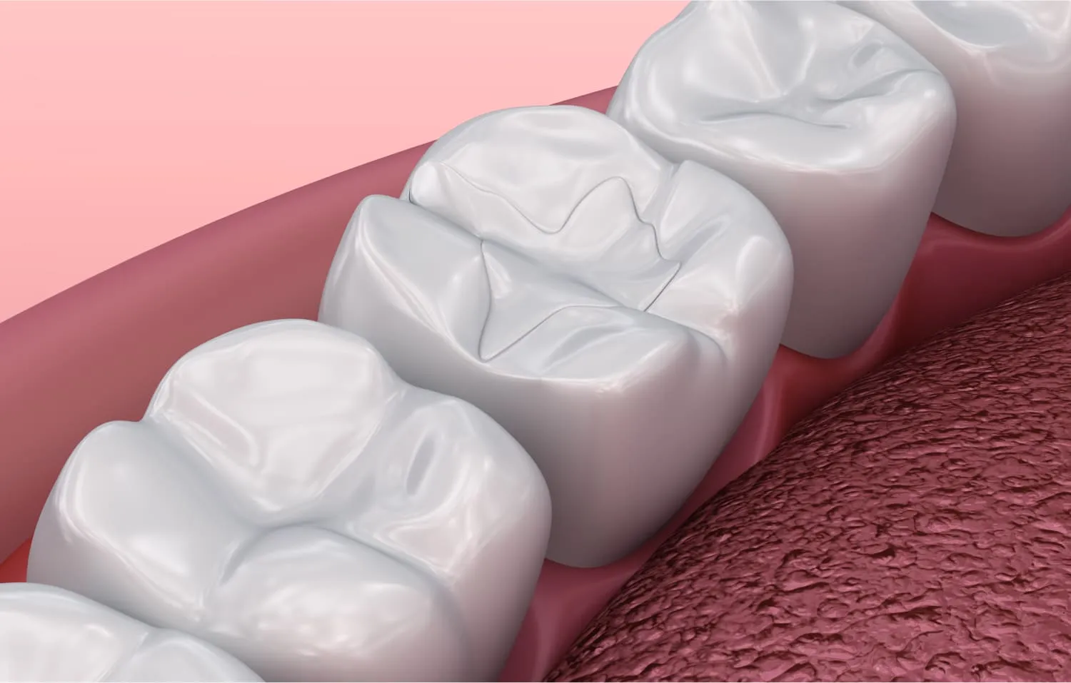 Inlays Onlays Consultation