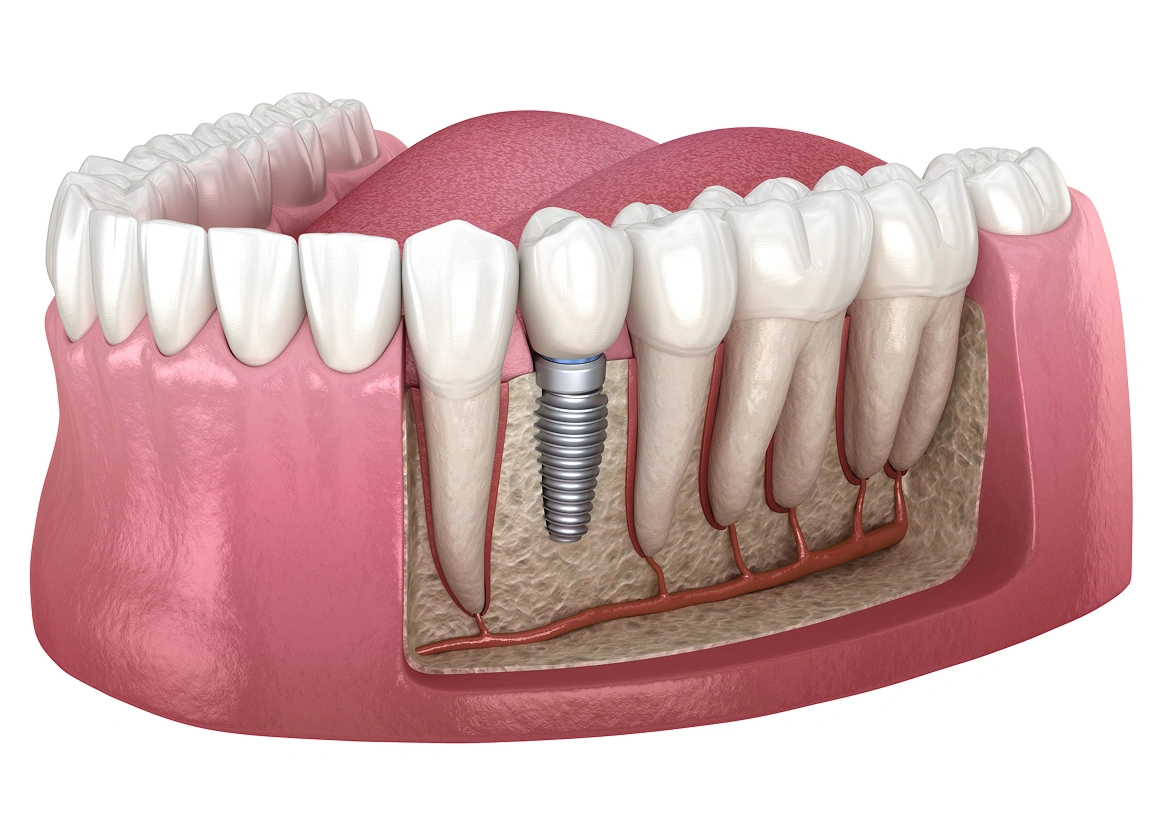 Dental implant benefits