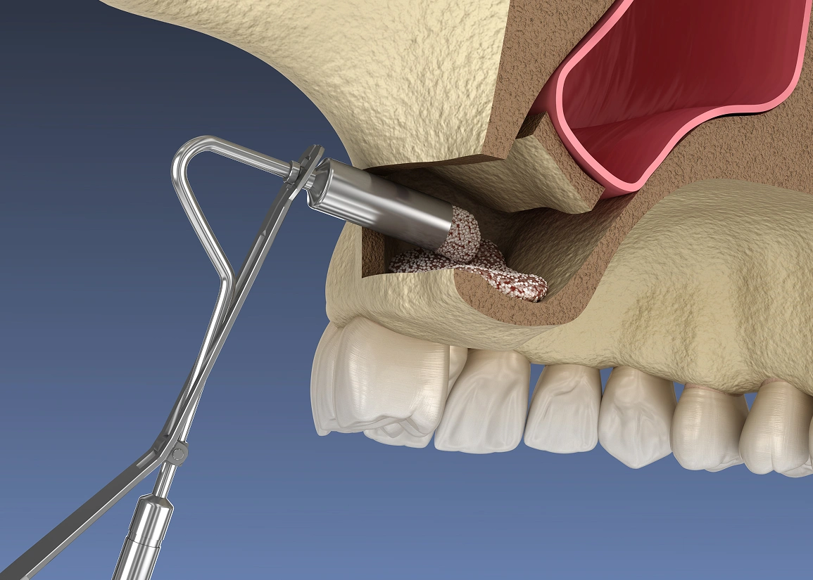 Sinus lift surgery procedure