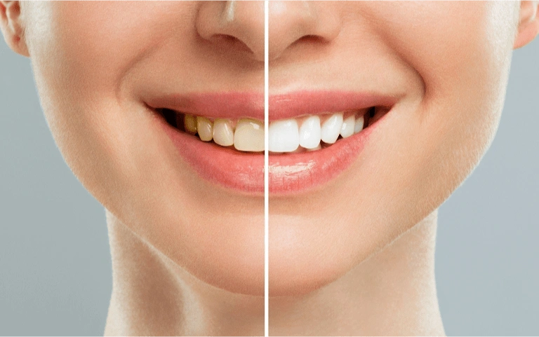 Professional teeth whitening
