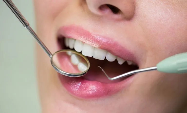 Tooth Colored Fillings